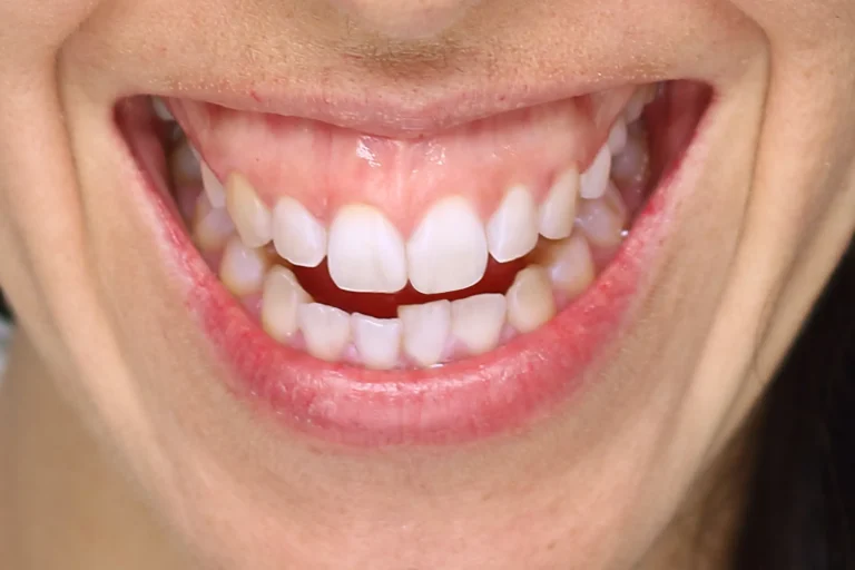 Gum Contouring