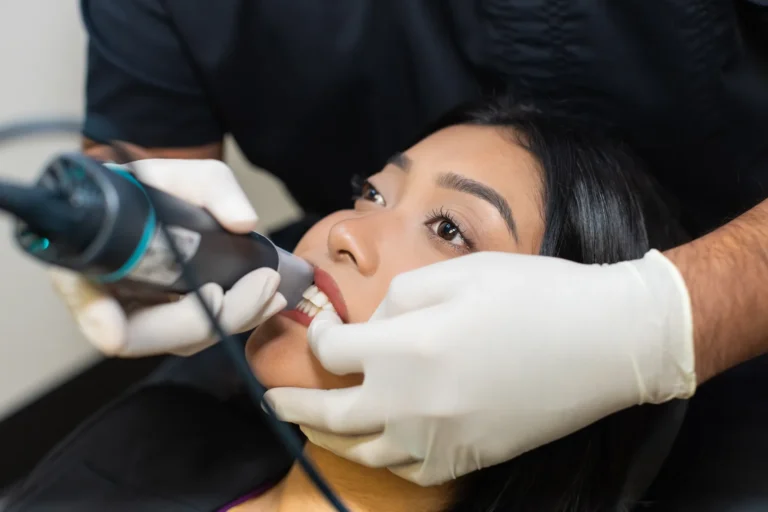 Veneers