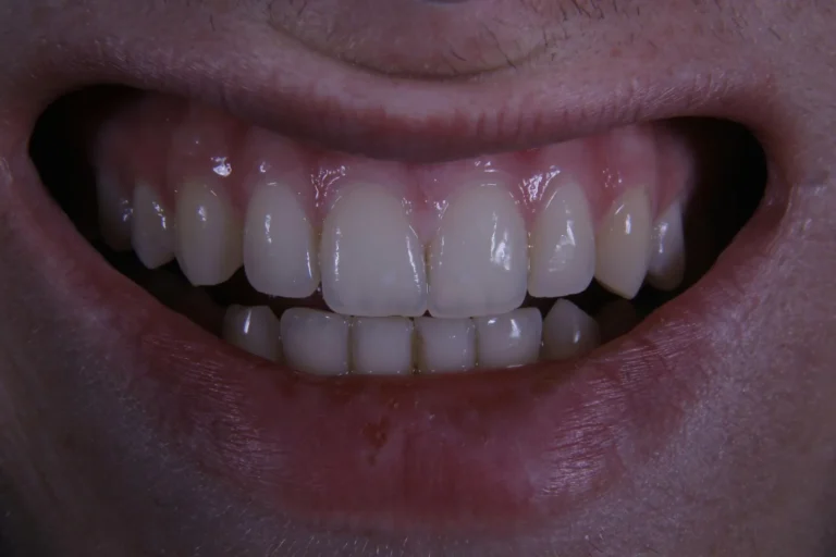 Conquer Gum Inflammation: Tips for Healthier Smiles
